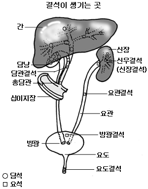 한번 생기면 자꾸 생기는 결석 해결방법