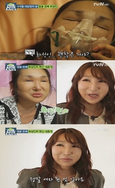 화성인 얼굴은폐녀 치아 심고 미모 심고…얼굴 되찾았다