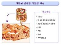 장의 게실병 주의보…서구화 된 식습관이 원인, 섬유질 섭취해야