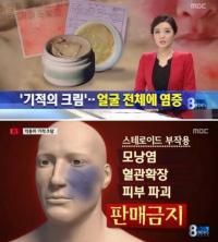 '기적의 크림' 부작용, 모남염․혈관확장․피부파괴까지 '끔찍'