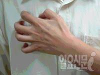 거제 고교 '옴' 집단 발병 "전염력 강해 접촉한 이들도 위험"