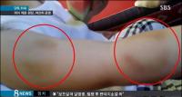 '친구 물지 마' 원생 깨문 어린이집 원장, 해명이 기막혀