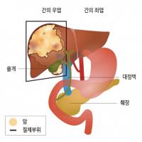 온종합병원 “20cm 거대 간암덩어리 수술로 완전 제거”