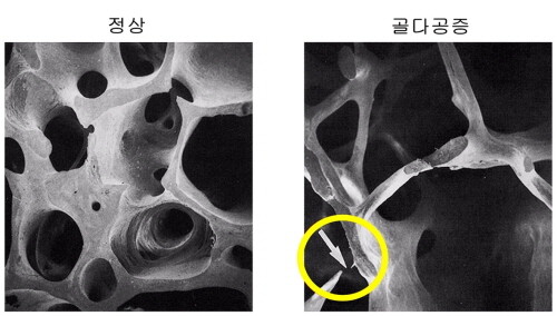 뼈단면비교사진(정상환자 골다공증환자)