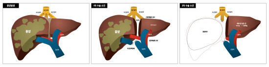 알프스(ALPPS) 수술 경과 그림. 사진=온종합병원 제공