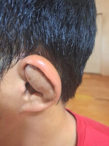 감금폭행을 당한 뒤 A 씨 귀가 만두처럼 부푼 모습. 사진=A 씨 측 제공