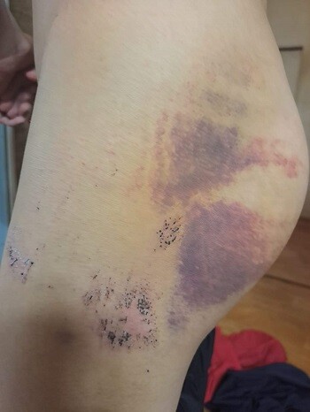 쇠파이프로 맞은 A 씨의 엉덩이. 멍이 조금 빠졌지만 여전히 맞은 흔적이 선명하다. 사진=A 씨 측 제공