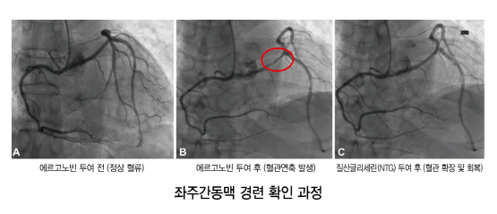 ‘좌주간동맥 경련’ 확인 과정. 사진=온병원 제공