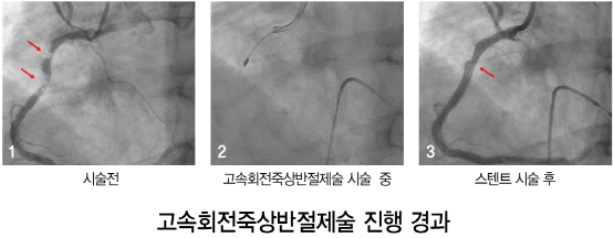 ‘고속회전 죽상반절제술’ 진행 경과 이미지. 사진=온병원 제공